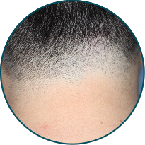 Low-BSA patient scalp after 3 doses of TREMFYA®