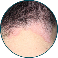 Low-BSA patient scalp before TREMFYA®