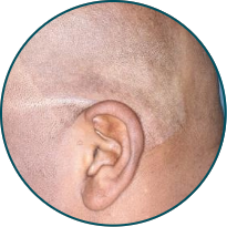 Low-BSA patient scalp behind the ear after 3 doses of TREMFYA®