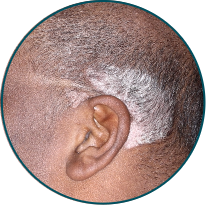 Low-BSA patient scalp behind the ear before TREMFYA®