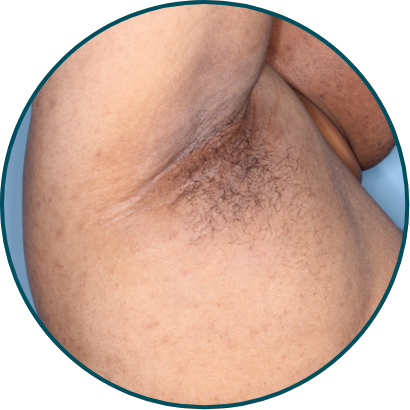 Low-BSA patient underarm skin folds after 3 doses of TREMFYA®
