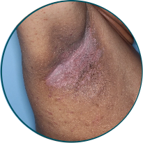 Low-BSA patient underarm skin folds before TREMFYA®