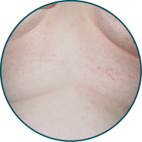 Low-BSA patient skin folds after 3 doses of TREMFYA®