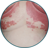 Low-BSA patient skin folds before TREMFYA®
