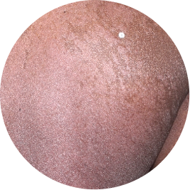 Patient back before TREMFYA® (identifies as African)