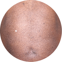 Patient chest after 3 doses of TREMFYA® (identifies as Caribbean)