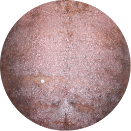 Patient chest before TREMFYA® (identifies as Caribbean)