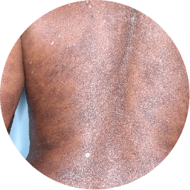 Patient back after 3 doses of TREMFYA® (identifies as Caribbean)