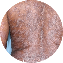 Patient back before TREMFYA® (identifies as Caribbean)