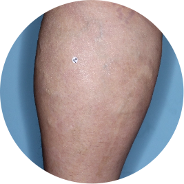 Patient leg after 3 doses of TREMFYA® (identifies as Mexican)