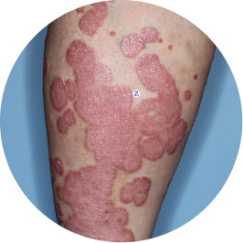 Patient leg before TREMFYA® (identifies as Mexican)