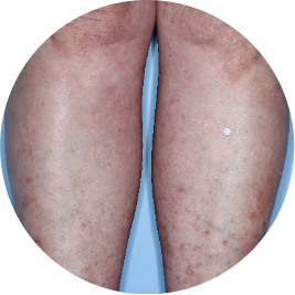 Patient legs after 3 doses of TREMFYA® (identifies as South American)
