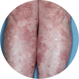 Patient legs before TREMFYA® (identifies as South American)