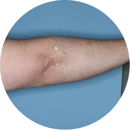 Patient arm after 3 doses of TREMFYA® (identifies as Mexican)