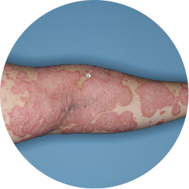 Patient arm before TREMFYA® (identifies as Mexican)