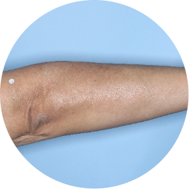 Patient forearm after 3 doses of TREMFYA® (identifies as Mexican)