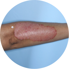 Patient forearm before TREMFYA® (identifies as Mexican)