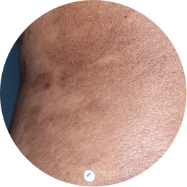 Patient back after 3 doses of TREMFYA® (identifies as South Asian)