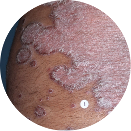 Patient back before TREMFYA® (identifies as South Asian)