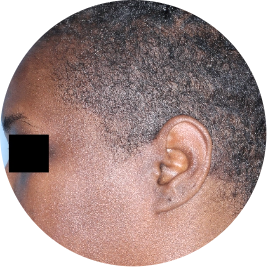 Patient scalp after 3 doses of TREMFYA® (identifies as Black)
