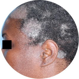 Patient scalp before TREMFYA® (identifies as Black)