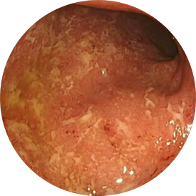 Image from an endoscopic procedure before TREMFYA<sup>®</sup> (guselkumab) for ulcerative colitis (UC)