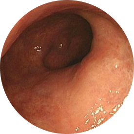 Image from an endoscopic procedure after 1 year on TREMFYA<sup>®</sup> (guselkumab) for ulcerative colitis (UC)